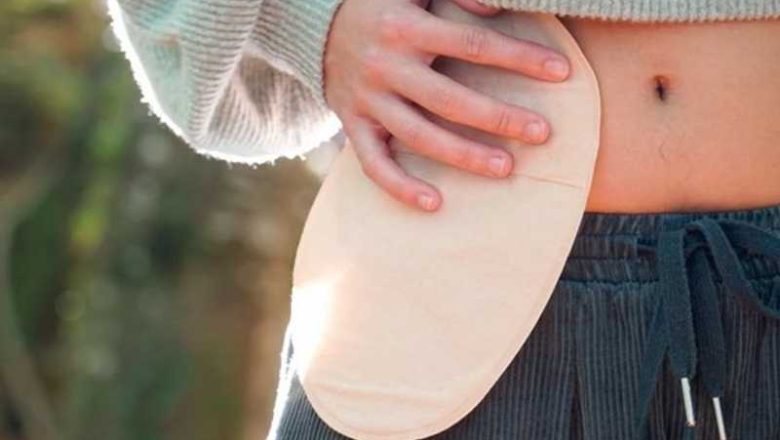 Prilagodba i svakodnevna rutina s urostomom